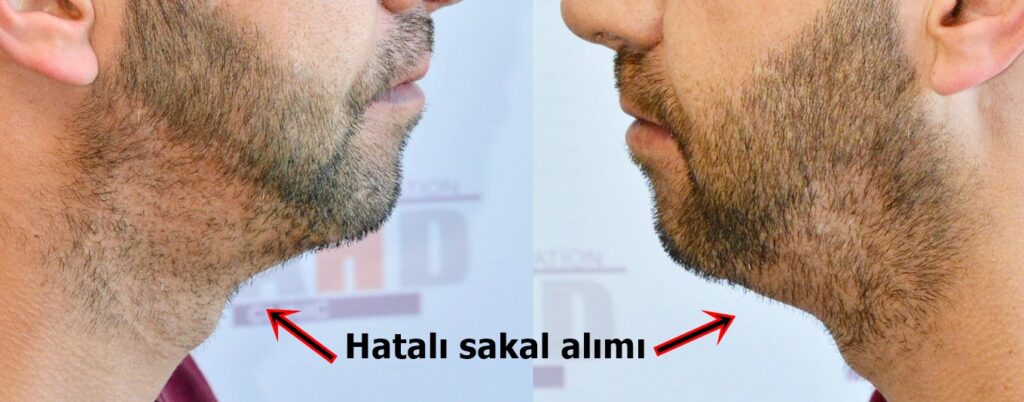 hatalı sakaldan alım örneği
