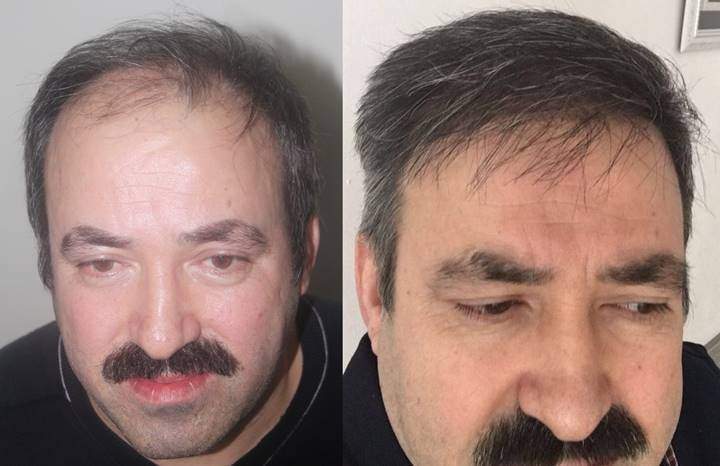 saç ekim sonuçları