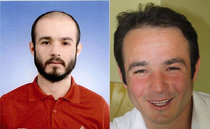 saç ekim sonucu