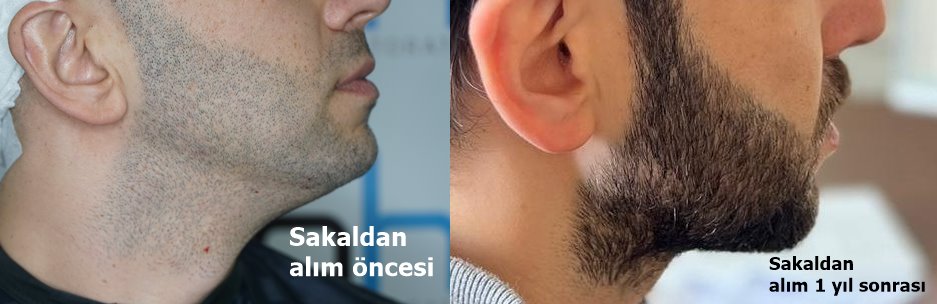 sakal kılından kafaya ekim