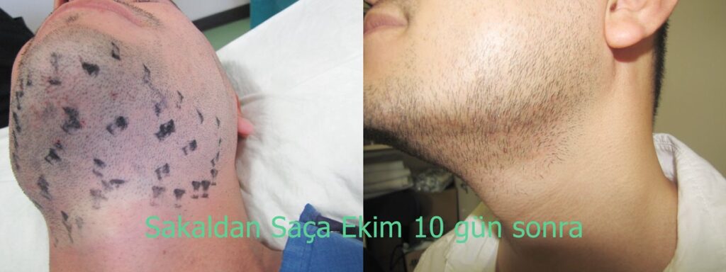 sakaldan ekim 