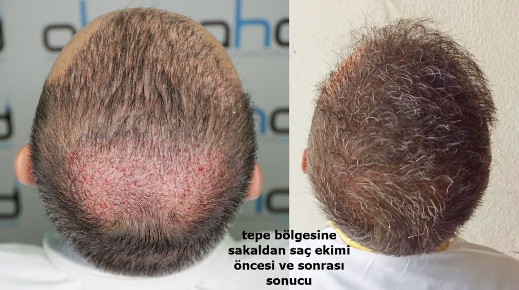 sakaldan saç ekim sonucu