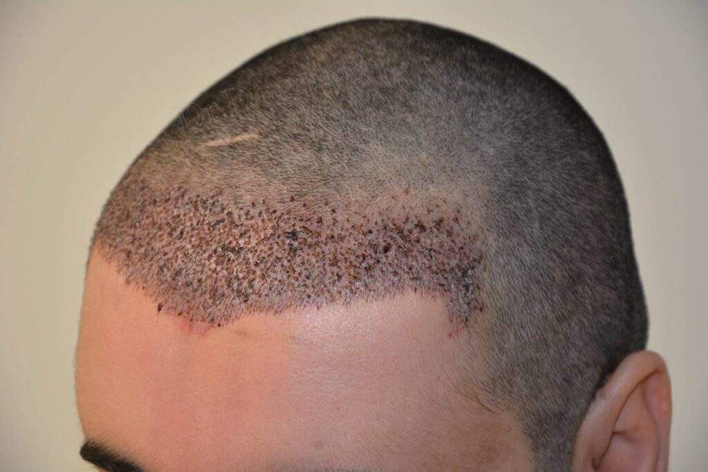 2000 grafts 3rd day