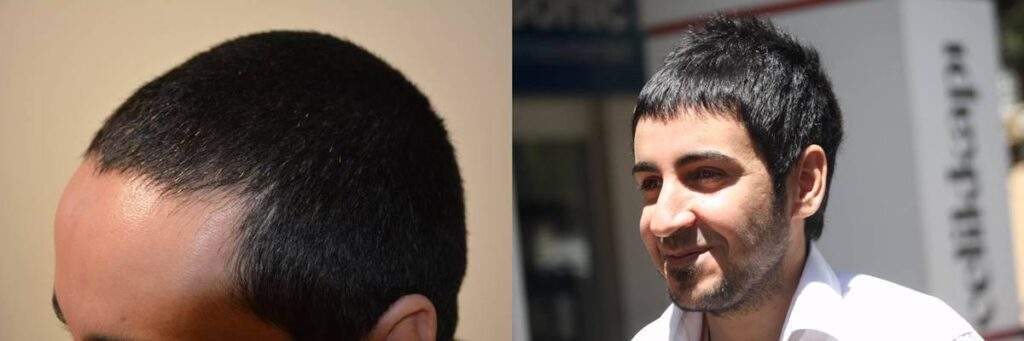 2000 grafts before after
