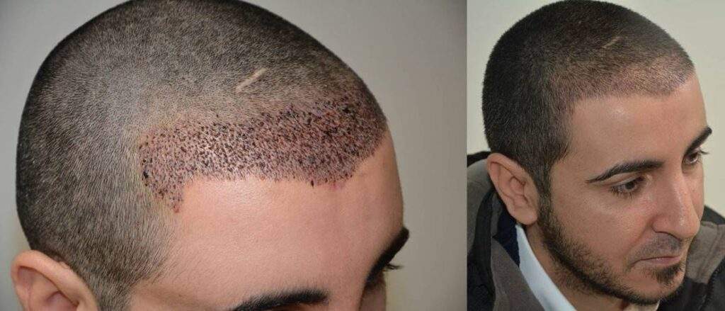 2000 grafts hair restoration