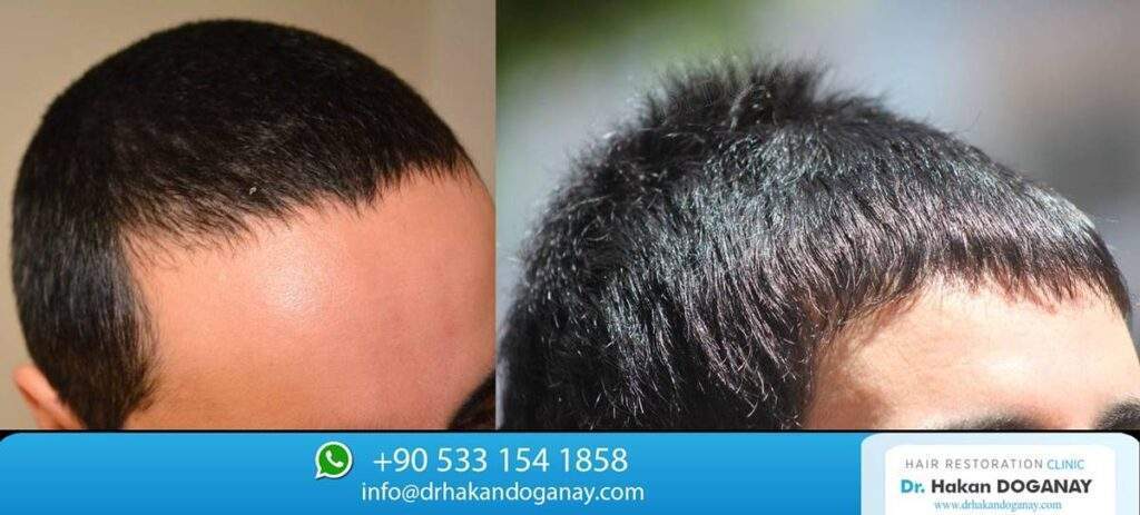 2000 grafts hair transplant before and after