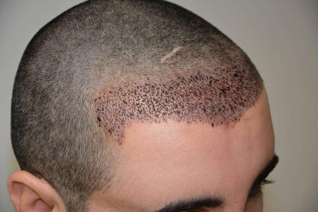 2000 grafts hairline 3 day