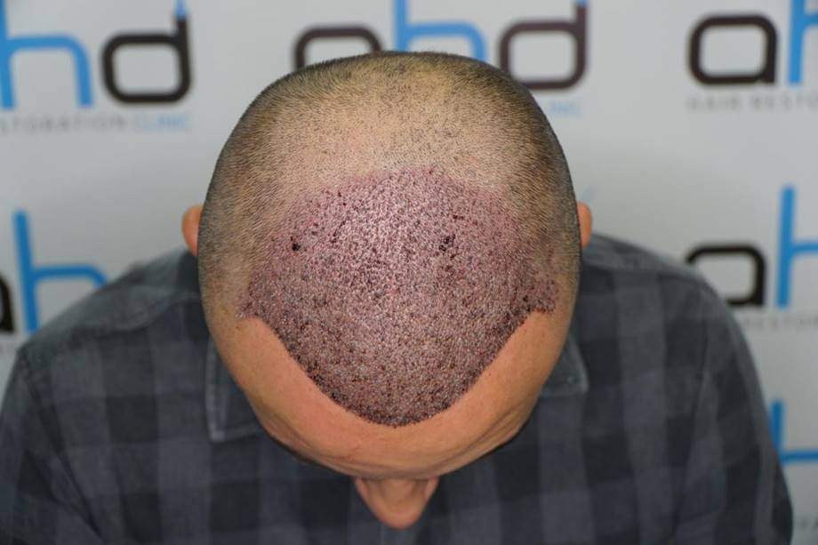 3 days after hair transplant