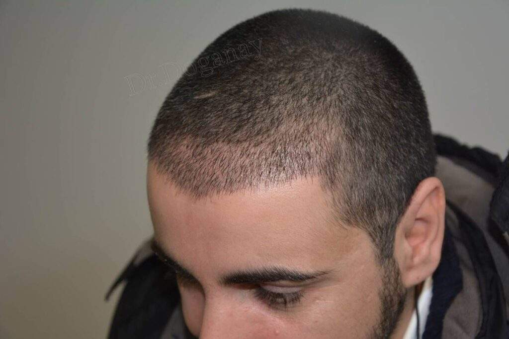 3 days after hair transplant