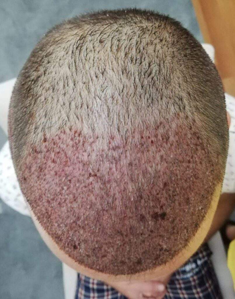 3000 grafts after 2 days