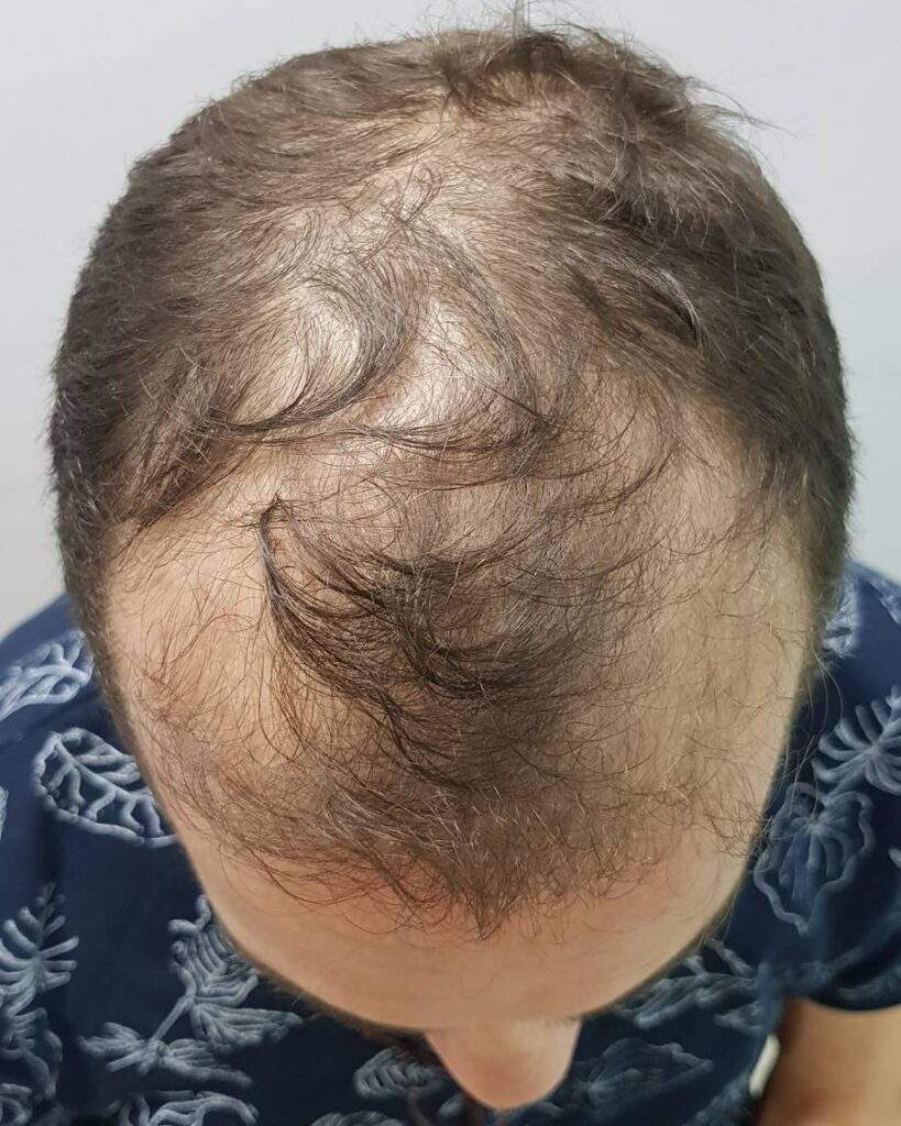 3000 grafts before dry