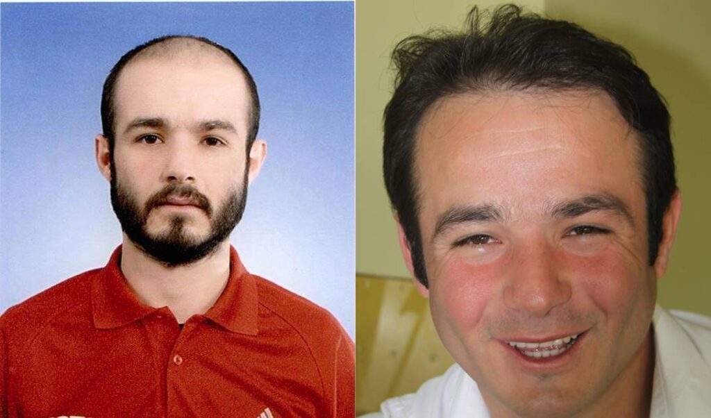 4000 grafts before after