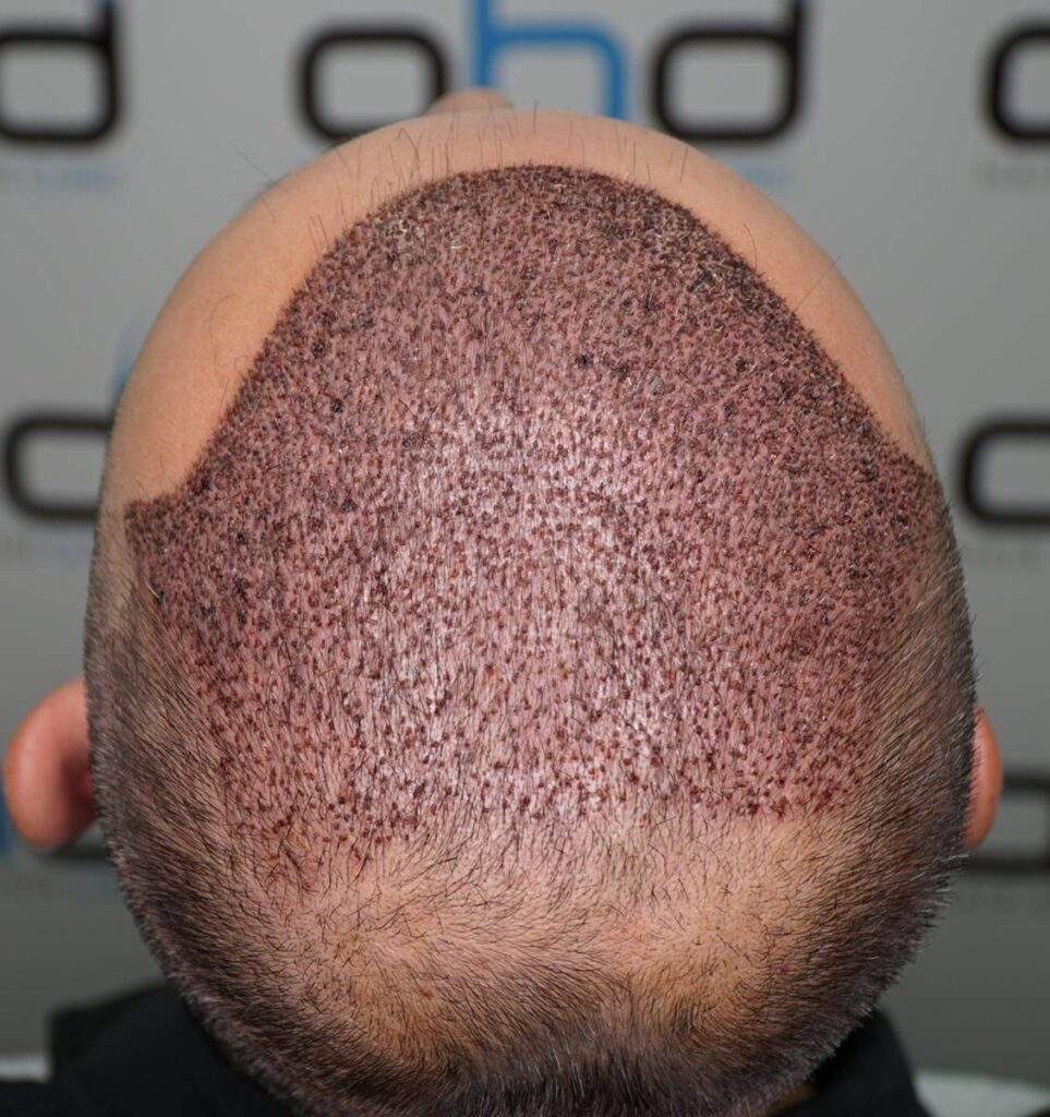 4500 grafts hair transplant 3 days