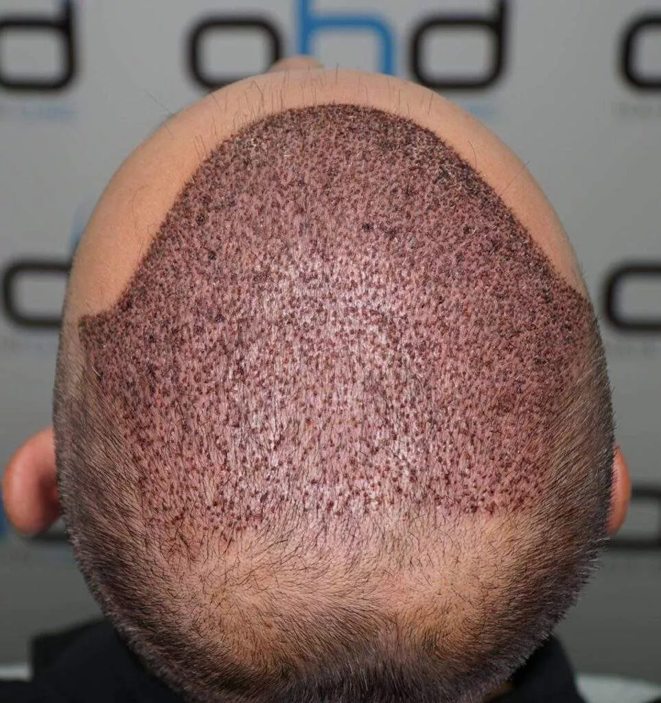 4500 grafts hair transplant 3 days