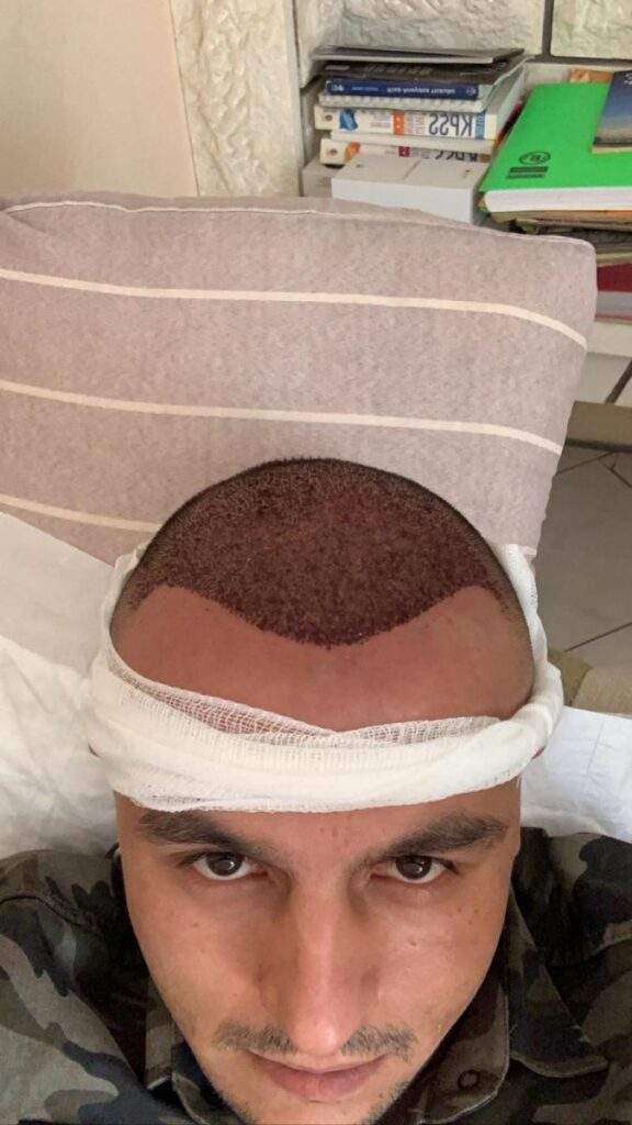 5 days after hair transplant