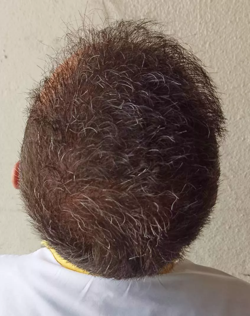 5000 grafts 1 year