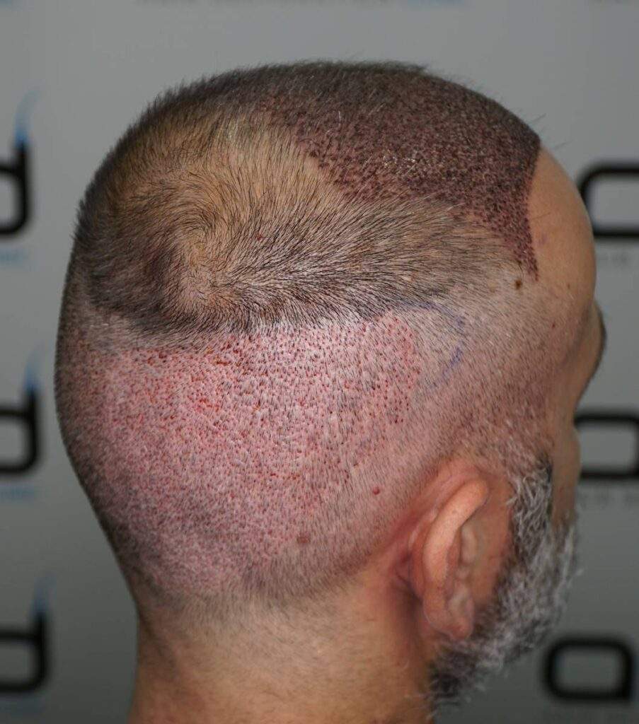 after hair transplant 3 days