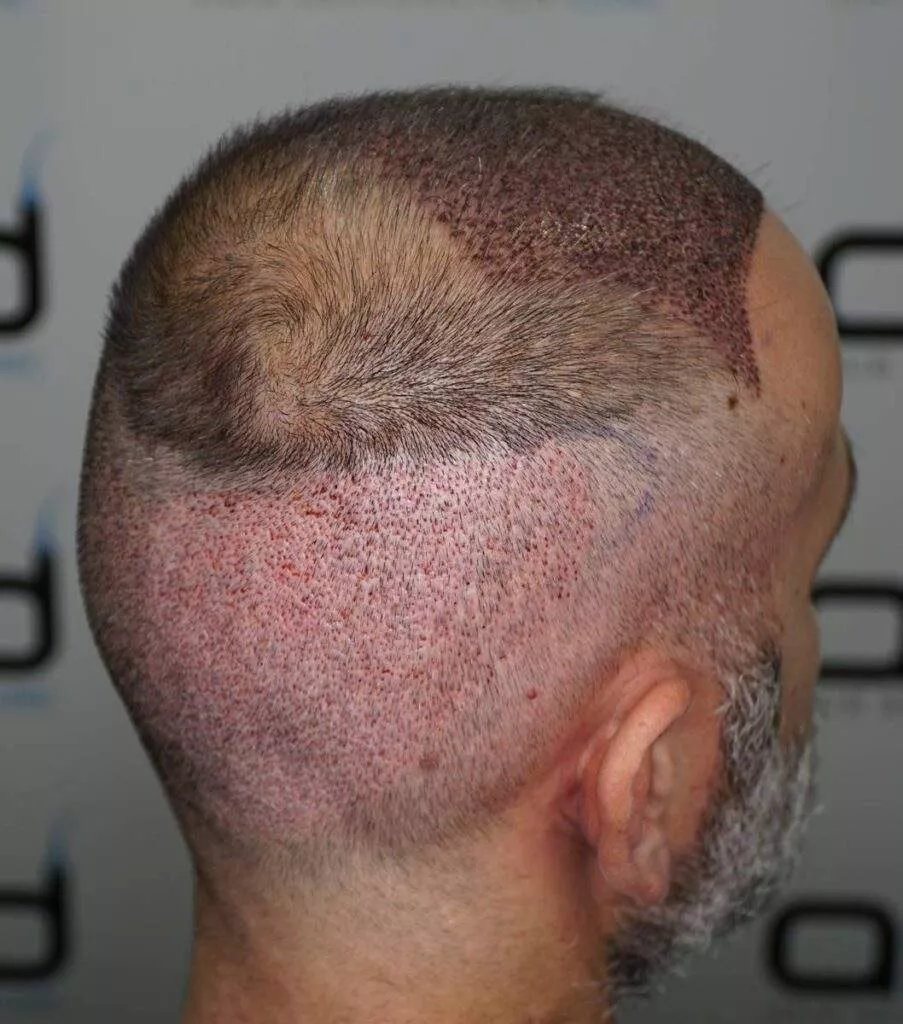 after hair transplant 3 days