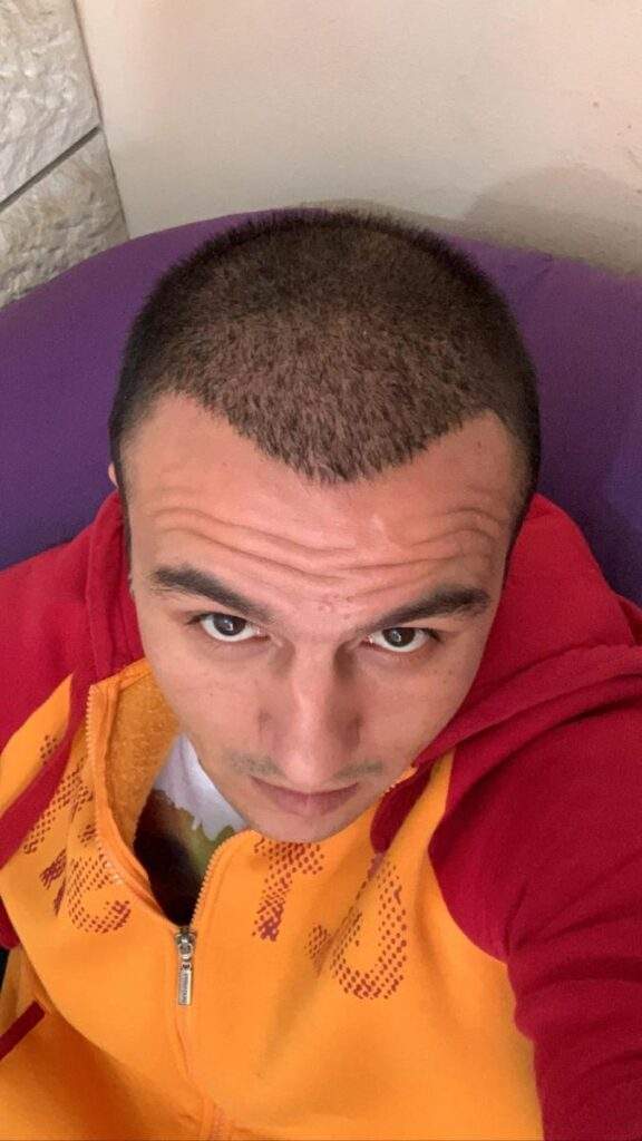 hair transplant 1 month