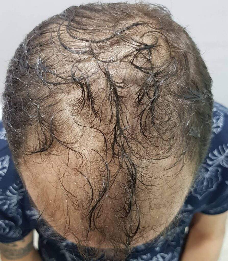 before 3000 grafts wet
