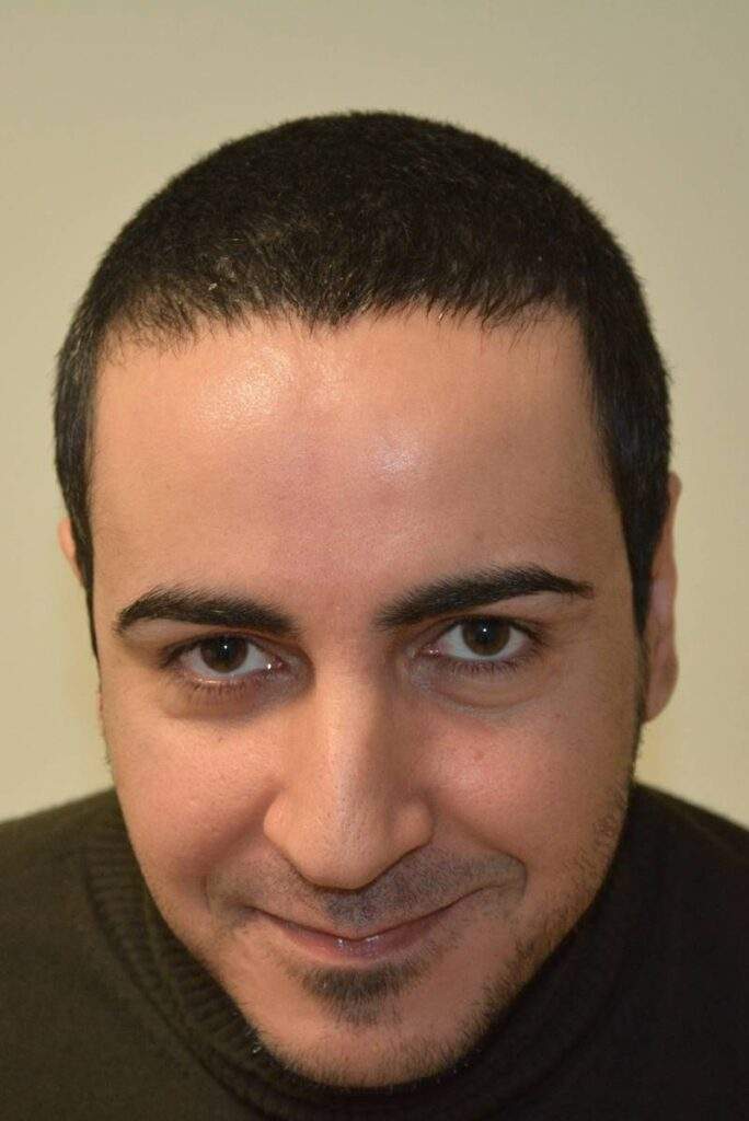 before hair transplant 2000 grafts