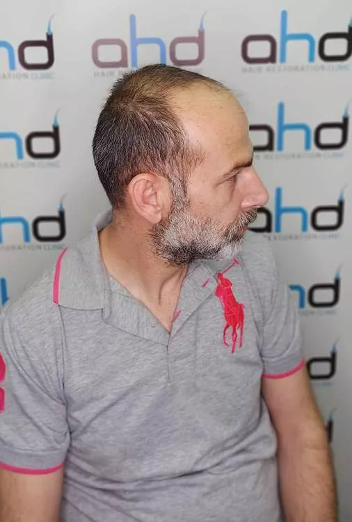 before hair transplant 5000 grafts