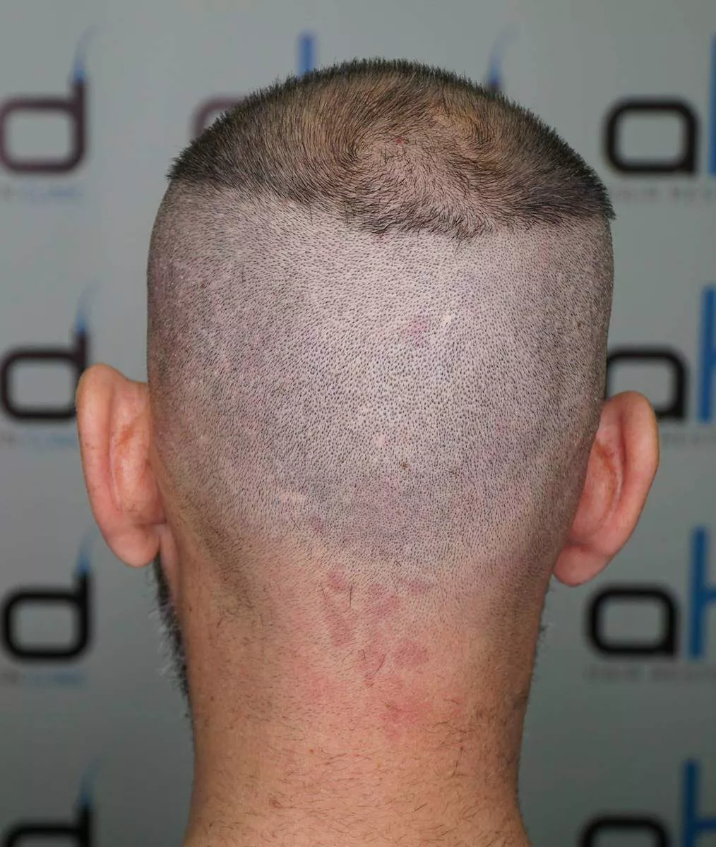 before hair transplant donor area