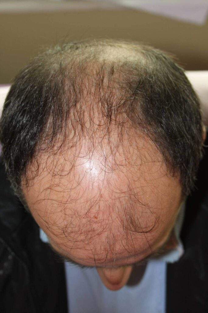 before hair transplant top