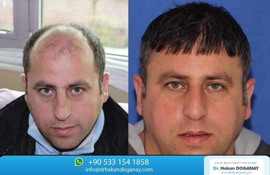 hair restoration 10000 grafts
