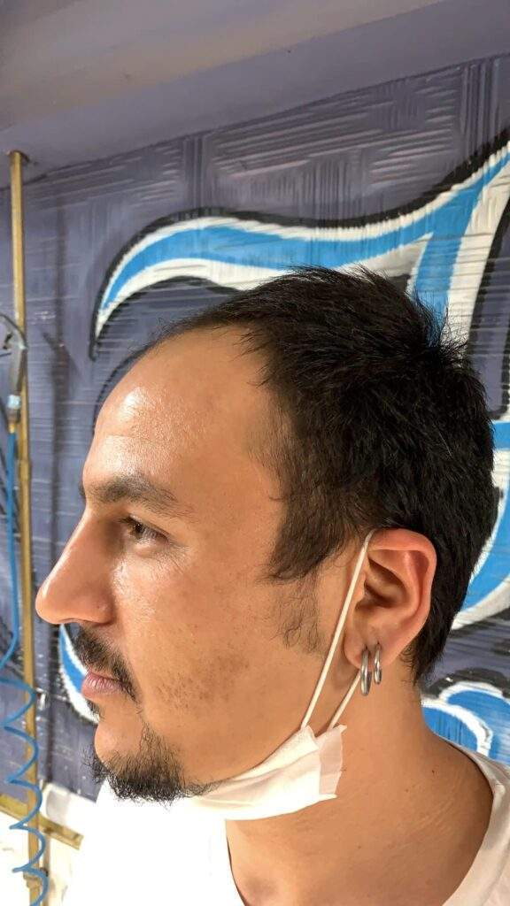 hair restoration left side