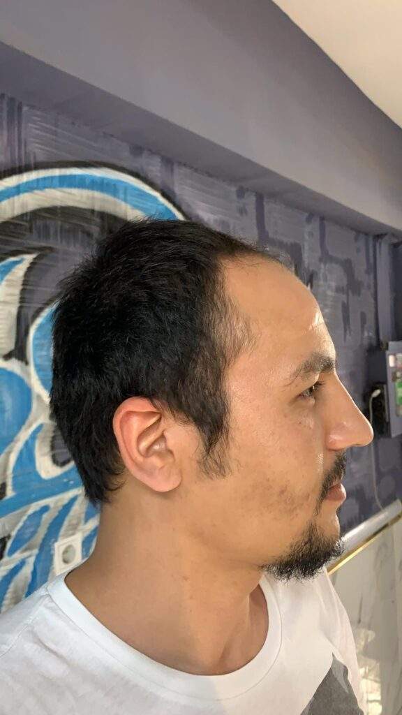 hair restoration right side