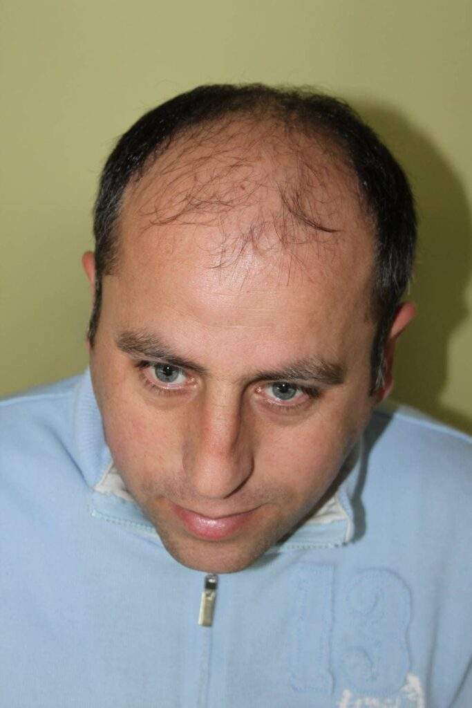 hair transplantation 10000 grafts before