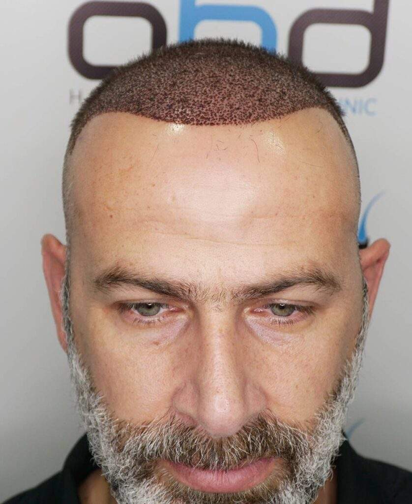 hair transplant 3 days