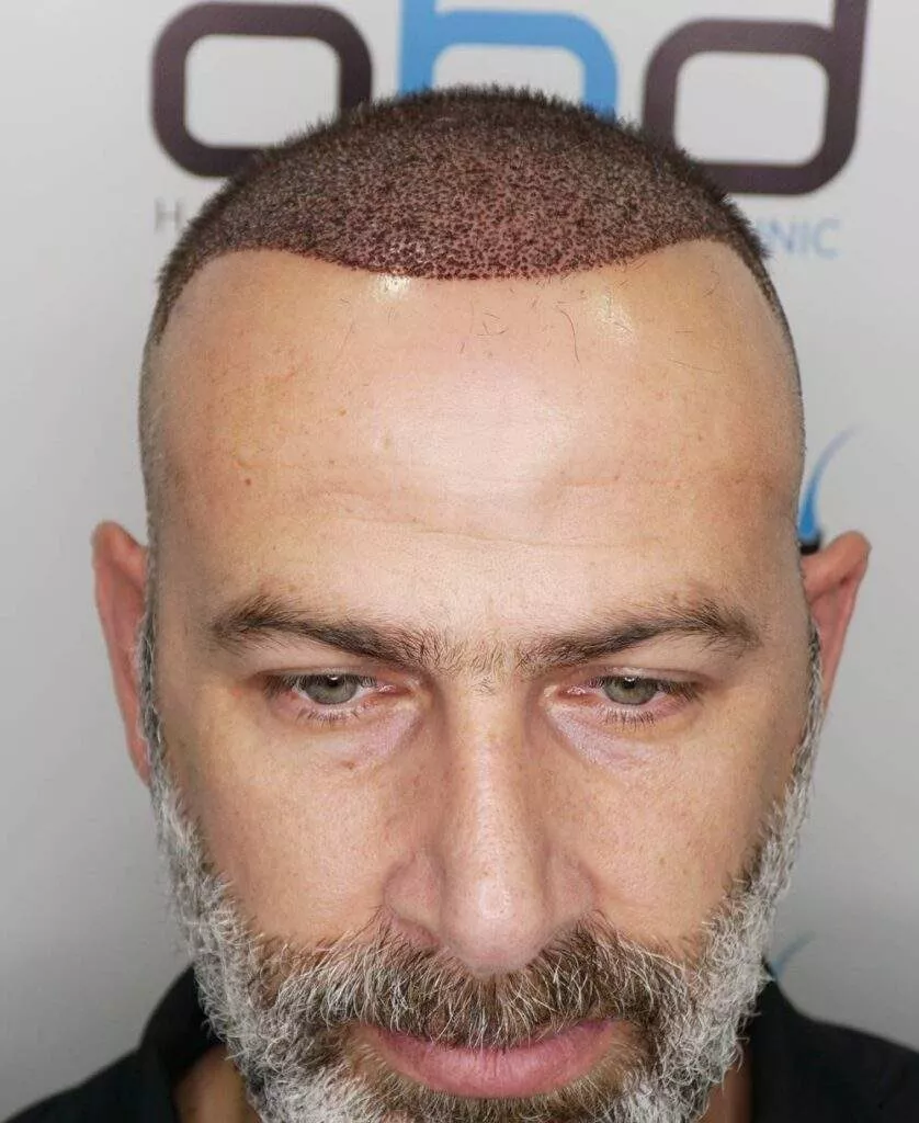 hair transplant 3 days