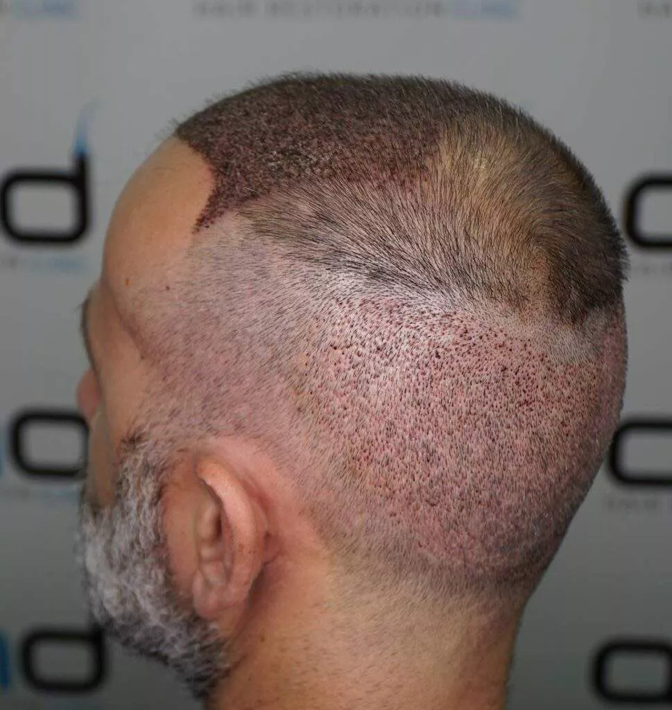hair transplant 3th day