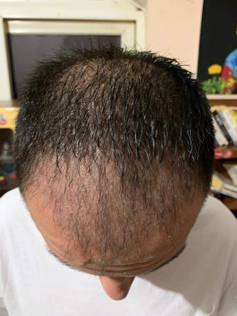 after 50 days hair transplant