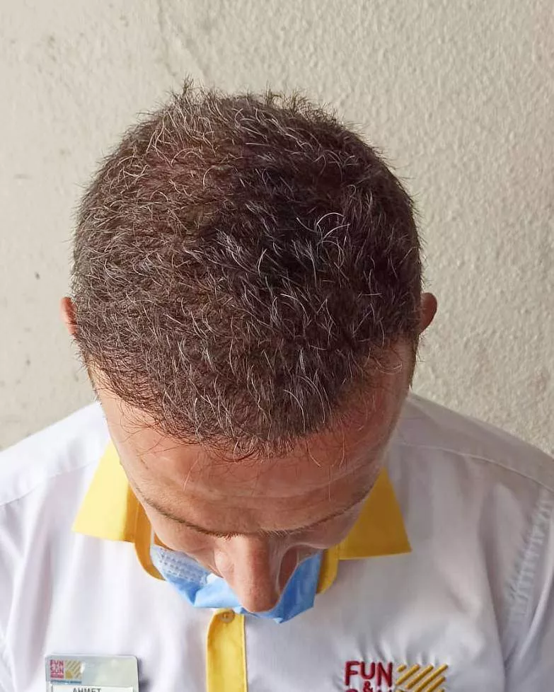 hair transplant 5000 grafts 1 year