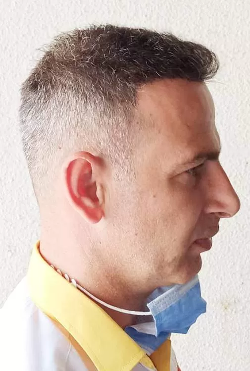 hair transplant 5000 grafts right side