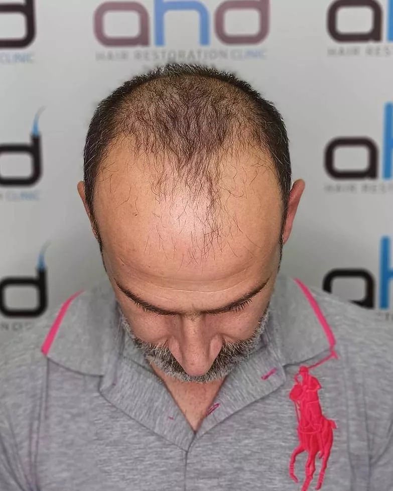 hair transplant before 5000 grafts