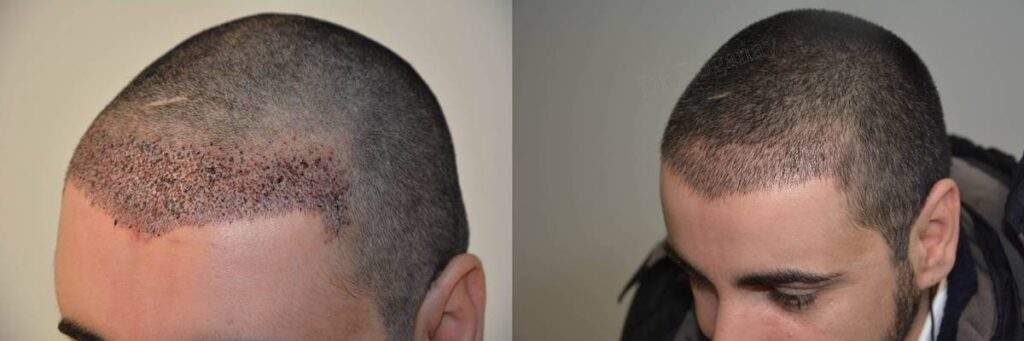 hair transplantation 2000 grafts