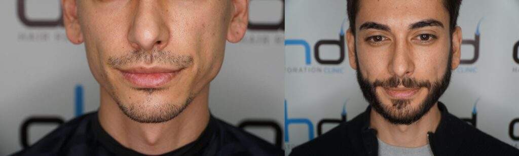 beard implant before after