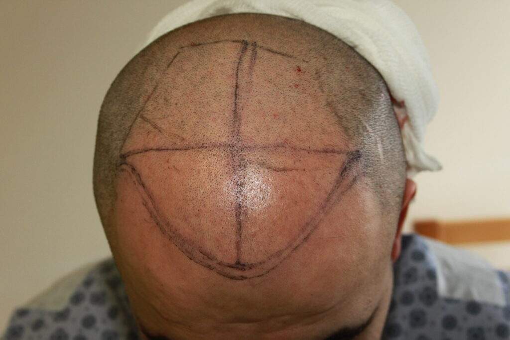 6000 grafts hairline