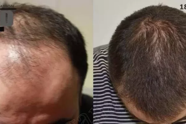 hair-transplant-6000-grafts-jpg