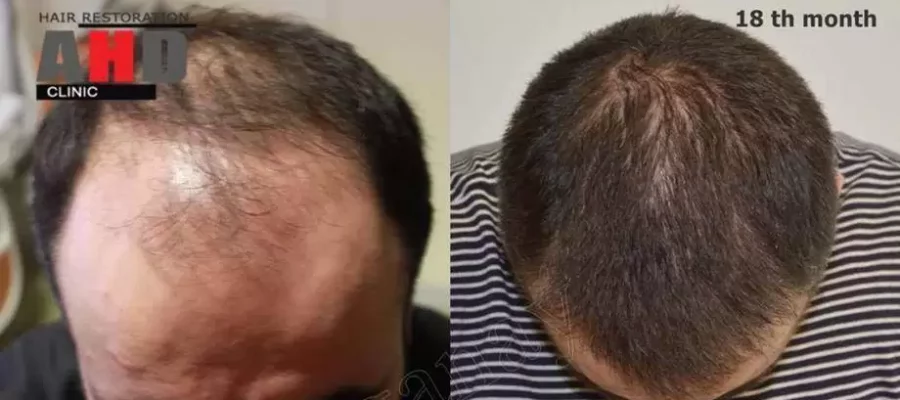 hair-transplant-6000-grafts-jpg