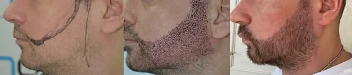 after beard transplant