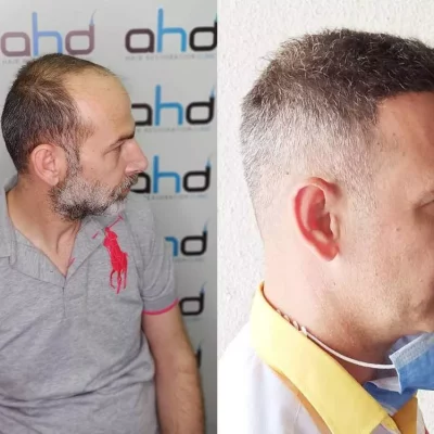 5000-grafts-hair-transplant.jpg