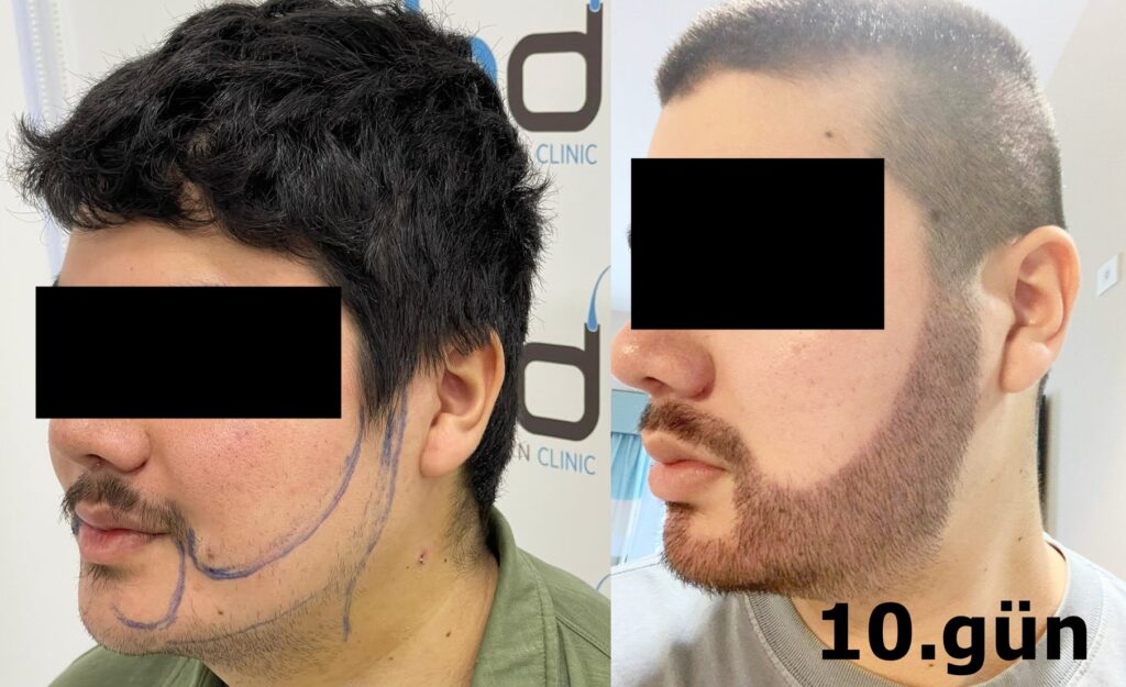 5000 greft sakal nakli 10.gün