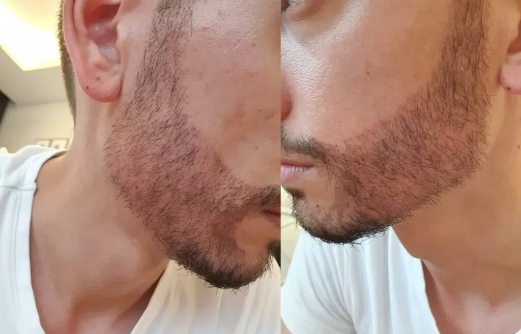 shock loss in beard transplantation