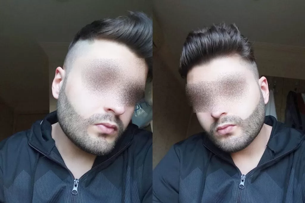 beard transplant day 10