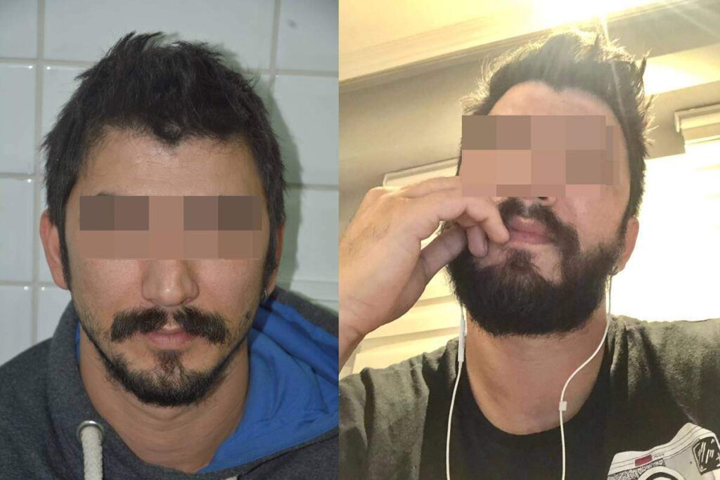 sakal ektirme öncesi sonrası
